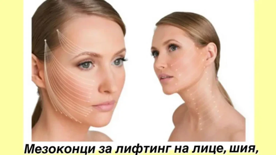 Лифтинг на лице с мезоконци Лифтинг на лице с мезоконци