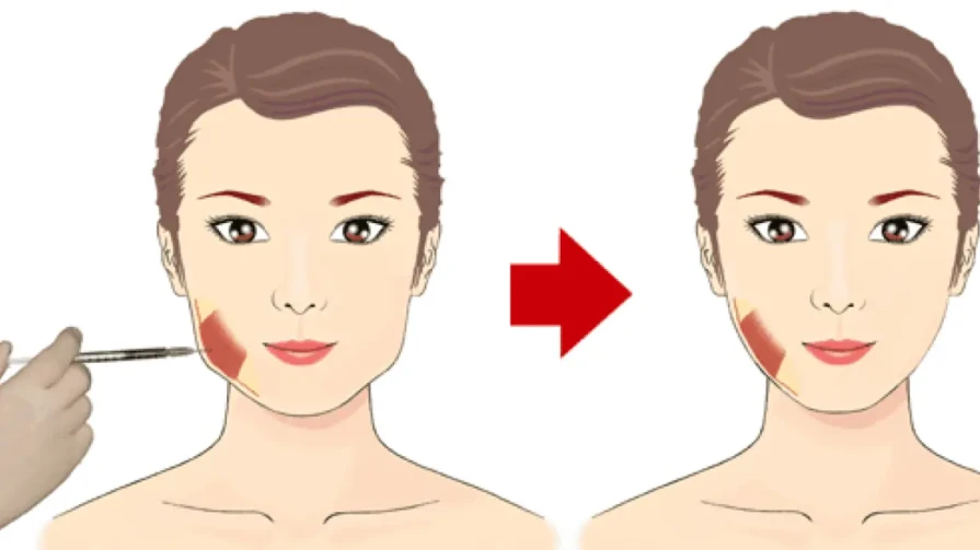 Tossicina botulinica per modellare l'ovale del viso (V-shape)