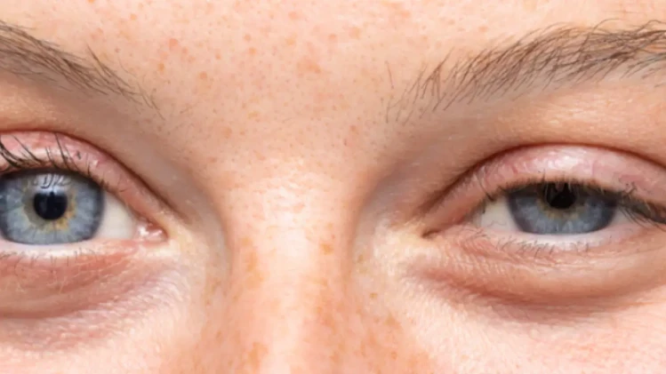 💉 Ботулинов токсин за лечение на често мигане (блефароспазъм) 💉 Ботулинов токсин за лечение на често мигане (блефароспазъм)