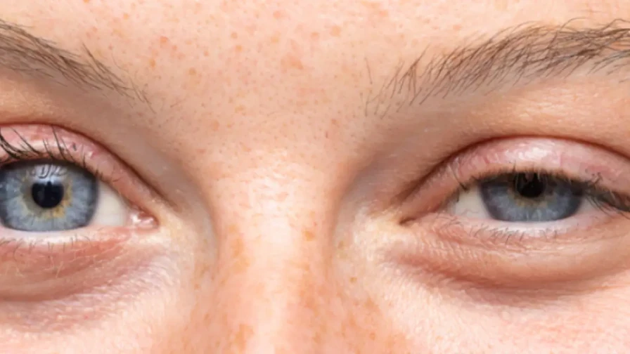 💉 Tossina botulinica per il trattamento del frequente lampeggio delle palpebre (blefarospasmo)