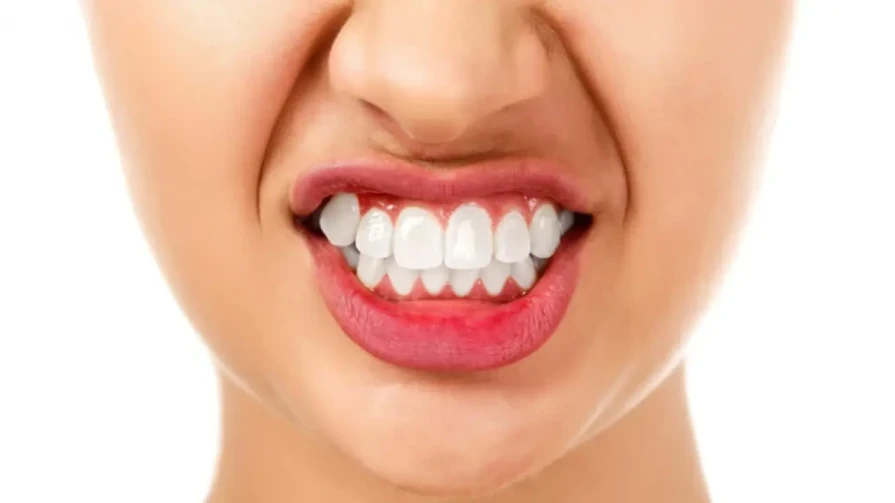 💉 Tossina botulinica per il trattamento del serraggio eccessivo dei denti (bruxismo)