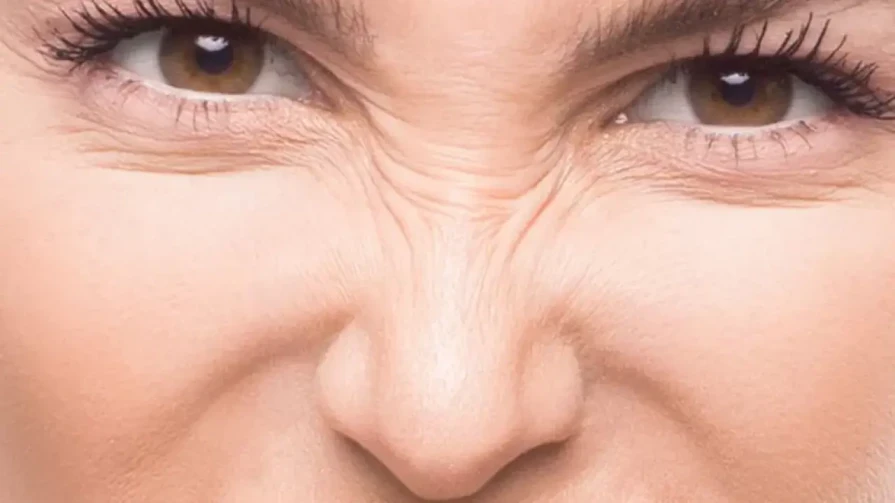 Tossine botulinica per il nasi (Linee del coniglio)