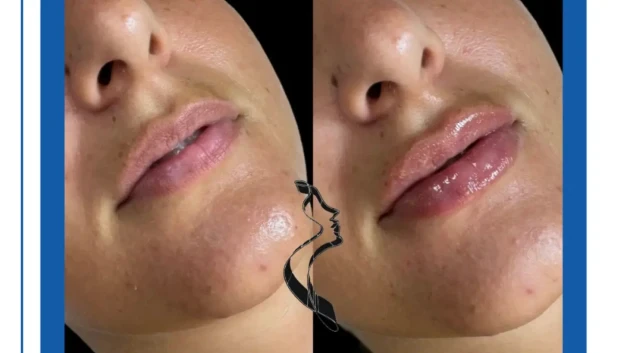 👄 Уголемяване на устни с 1.0 мл филър 👄 Уголемяване на устни с 1.0 мл филър