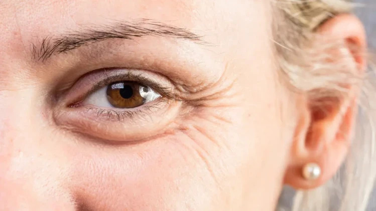 💉 Ботулинов токсин на пачи крак (Crow's feet) 💉 Ботулинов токсин на пачи крак (Crow's feet)