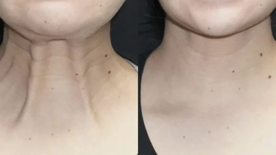 Tossico botulinico per lifting del collo (Nefertiti Lifting)