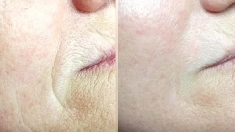 Професионална лифтинг процедура с колагенови конци с биоферментирала козметика SANMARINE Професионална лифтинг процедура с колагенови конци с биоферментирала козметика SANMARINE