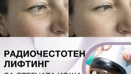 Радиочестотен лифтинг (цяло лице) Радиочестотен лифтинг (цяло лице)