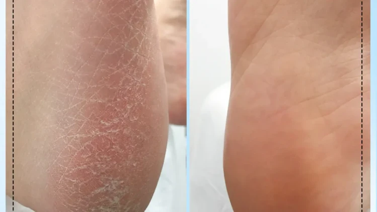 Медицински педикюр Медицински педикюр