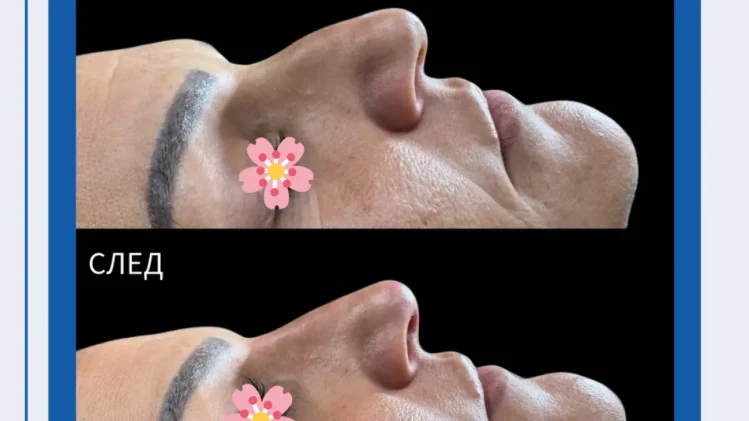 👃 Hiyaluronik asit dolgusu ile burun düzeltmesi (sıvı rinoplasti)