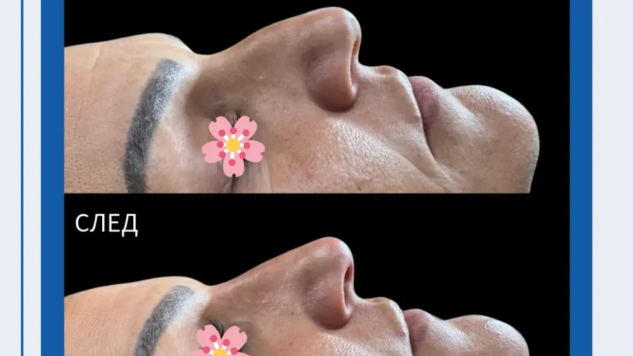👃 Корекция на нос с хиалуронов филър (течна ринопластика) 👃 Корекция на нос с хиалуронов филър (течна ринопластика)