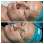 Терапия CSI на Fabbrimarine Терапия CSI на Fabbrimarine