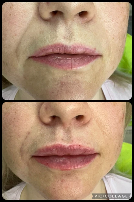 поставяне на филър поставяне на филър