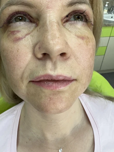 поставяне на филър поставяне на филър