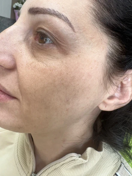 Поставяне на колагеностимулиращ филър/HArmoniCA,Ellanse,Juvelook,Lenisna Поставяне на колагеностимулиращ филър/HArmoniCA,Ellanse,Juvelook,Lenisna