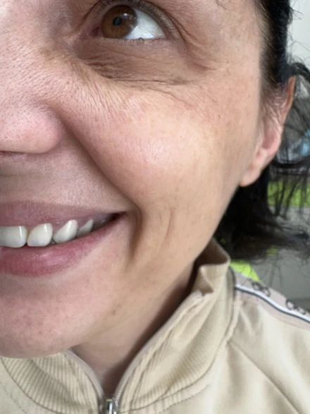 Поставяне на колагеностимулиращ филър/HArmoniCA,Ellanse,Juvelook,Lenisna Поставяне на колагеностимулиращ филър/HArmoniCA,Ellanse,Juvelook,Lenisna