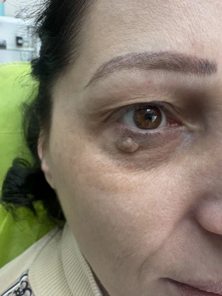 Поставяне на колагеностимулиращ филър/HArmoniCA,Ellanse,Juvelook,Lenisna Поставяне на колагеностимулиращ филър/HArmoniCA,Ellanse,Juvelook,Lenisna