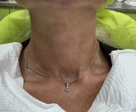 Поставяне на колагеностимулиращ филър/HArmoniCA,Ellanse,Juvelook,Lenisna Поставяне на колагеностимулиращ филър/HArmoniCA,Ellanse,Juvelook,Lenisna