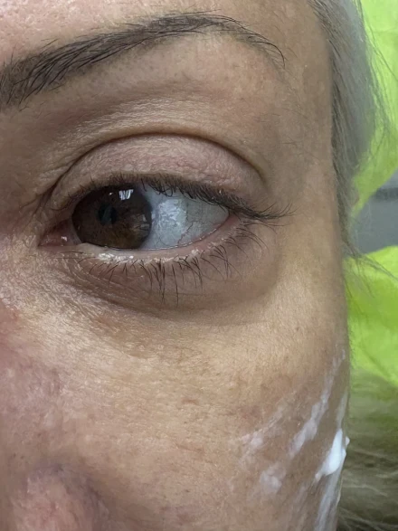 Поставяне на колагеностимулиращ филър/HArmoniCA,Ellanse,Juvelook,Lenisna Поставяне на колагеностимулиращ филър/HArmoniCA,Ellanse,Juvelook,Lenisna