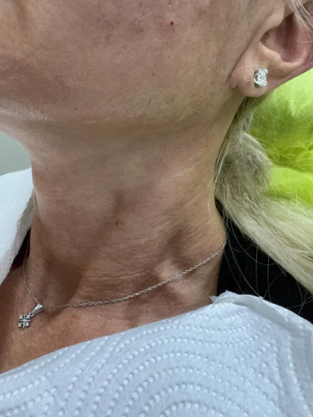 Поставяне на колагеностимулиращ филър/HArmoniCA,Ellanse,Juvelook,Lenisna Поставяне на колагеностимулиращ филър/HArmoniCA,Ellanse,Juvelook,Lenisna