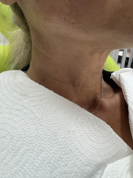 Поставяне на колагеностимулиращ филър/HArmoniCA,Ellanse,Juvelook,Lenisna Поставяне на колагеностимулиращ филър/HArmoniCA,Ellanse,Juvelook,Lenisna