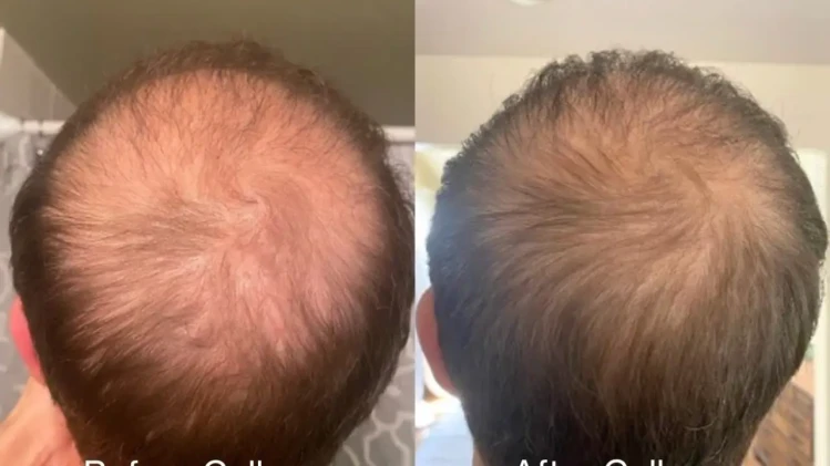 Celluma Led Therapy косопад и оплешивяване Celluma Led Therapy косопад и оплешивяване