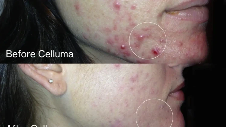 Celluma Led Therapy при акне Celluma Led Therapy при акне