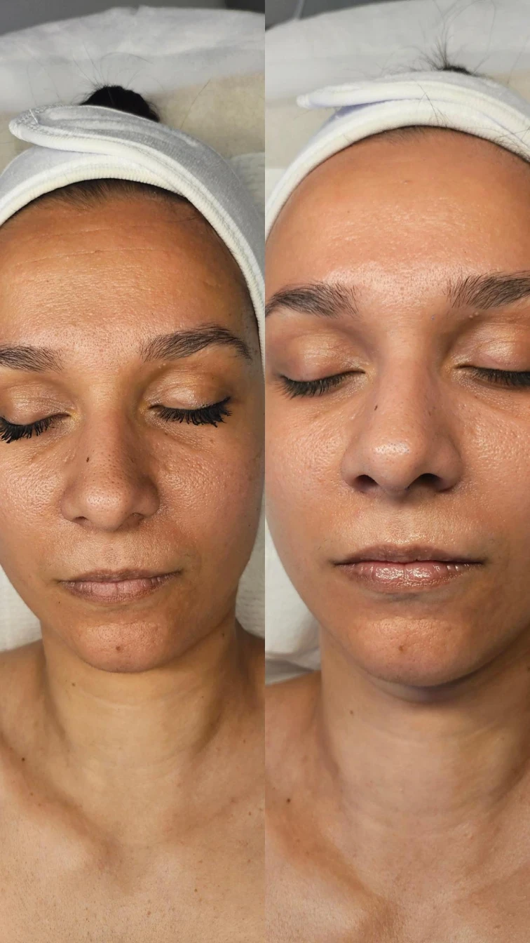 Ester C- изсветляваща и анти-ейдж терапия