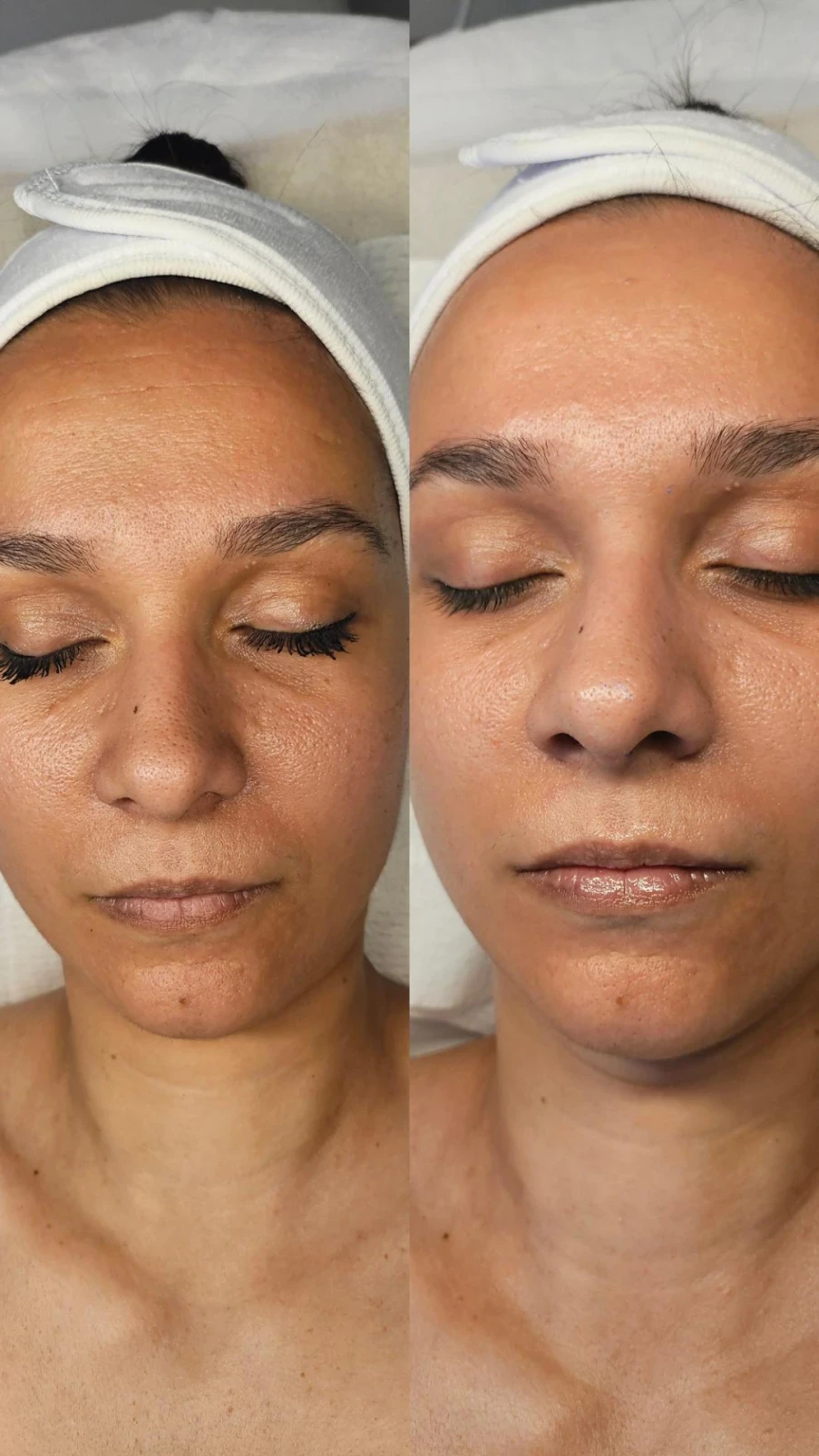 Ester C- изсветляваща и анти-ейдж терапия Ester C- изсветляваща и анти-ейдж терапия