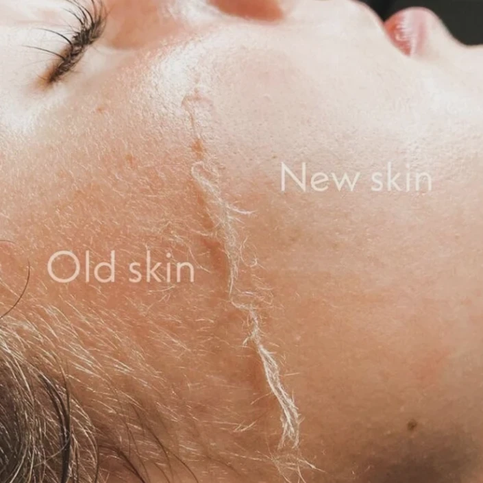 Дермапланинг Дермапланинг