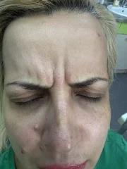 мезотерапия