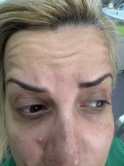 мезотерапия мезотерапия