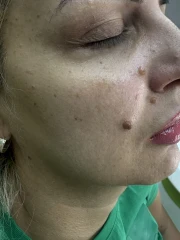 мезотерапия мезотерапия