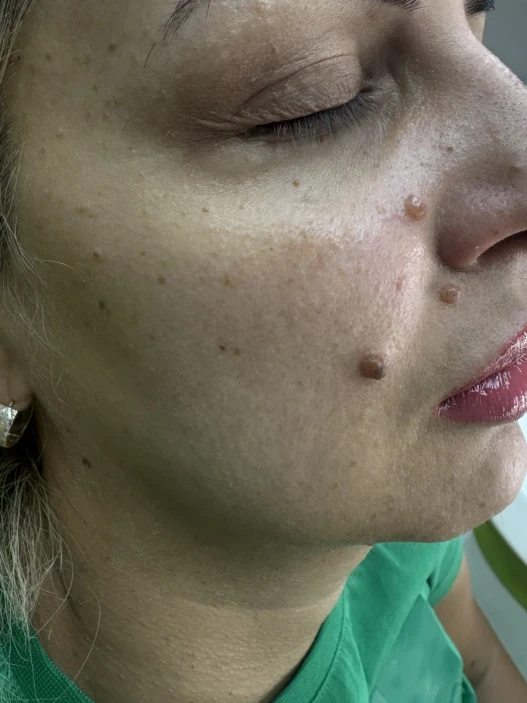 мезотерапия