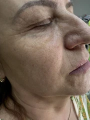 мезотерапия мезотерапия