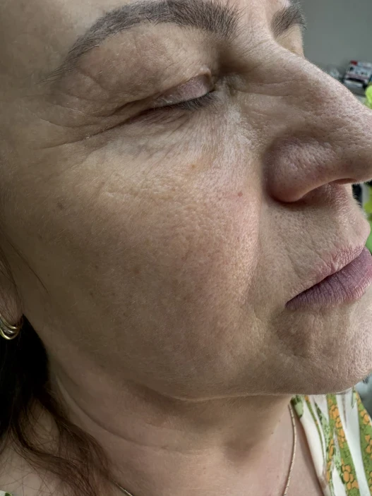 мезотерапия