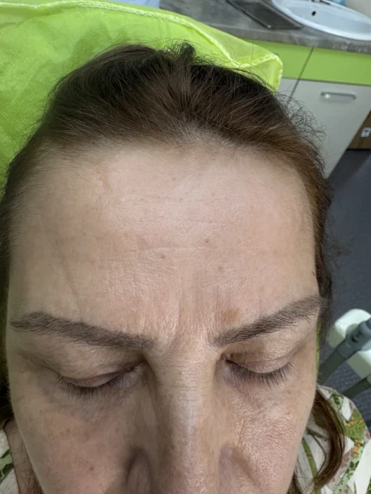 мезотерапия