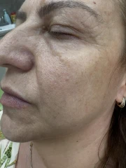 мезотерапия мезотерапия