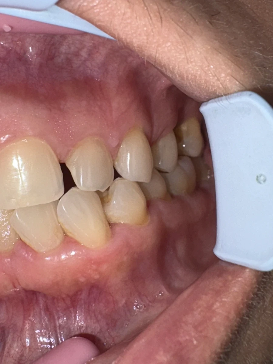 отпечатък за алайнери - Reservation.Studio