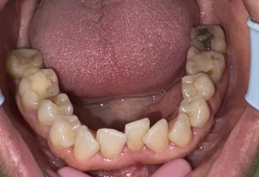 отпечатък за алайнери отпечатък за алайнери