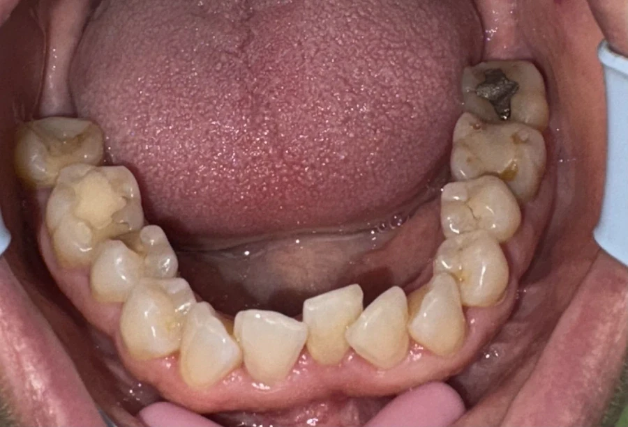 отпечатък за алайнери - Reservation.Studio