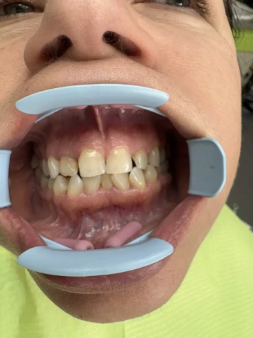 отпечатък за алайнери