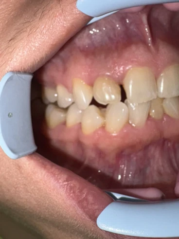 отпечатък за алайнери