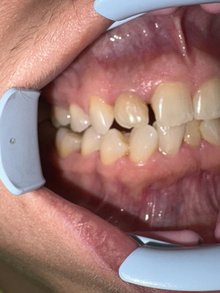 отпечатък за алайнери - Reservation.Studio отпечатък за алайнери - Reservation.Studio