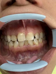 отпечатък за алайнери отпечатък за алайнери