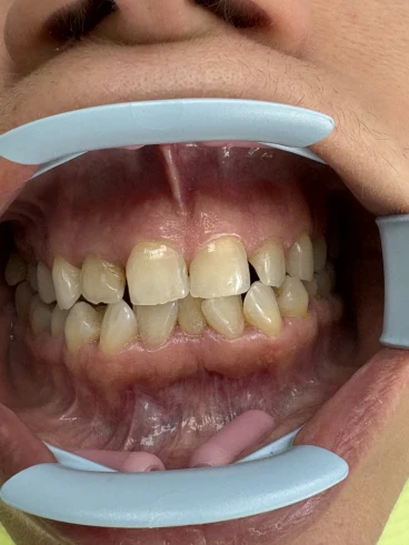 отпечатък за алайнери