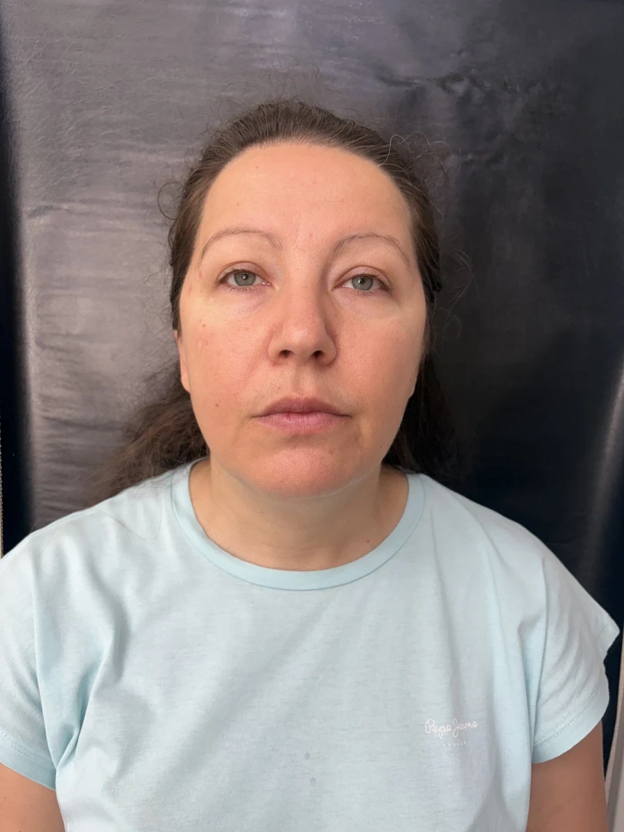 отпечатък за алайнери - Reservation.Studio отпечатък за алайнери - Reservation.Studio