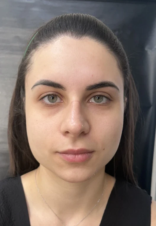 мезотерапия