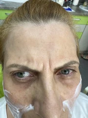 поставяне на ботокс