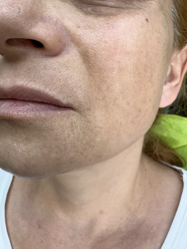 поставяне на ботокс - Reservation.Studio поставяне на ботокс - Reservation.Studio