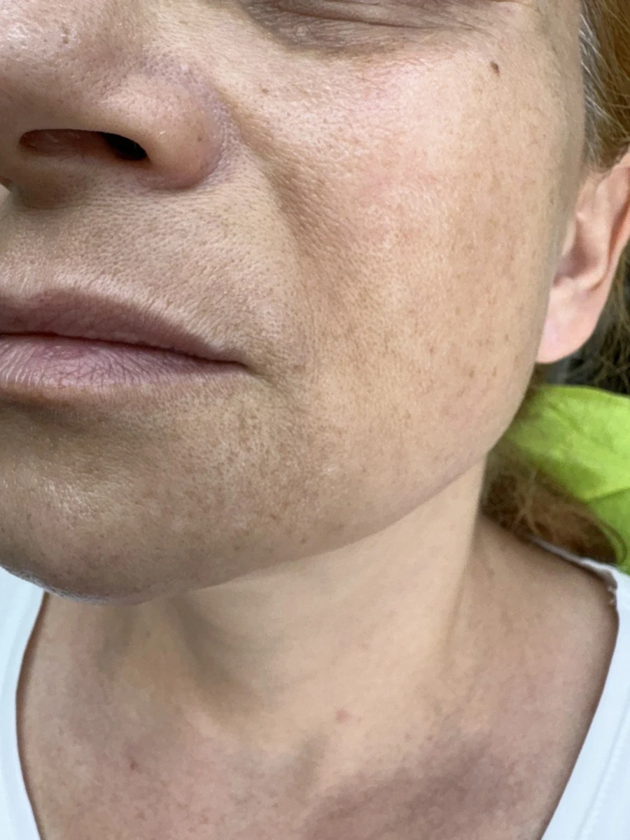 поставяне на ботокс - Reservation.Studio поставяне на ботокс - Reservation.Studio